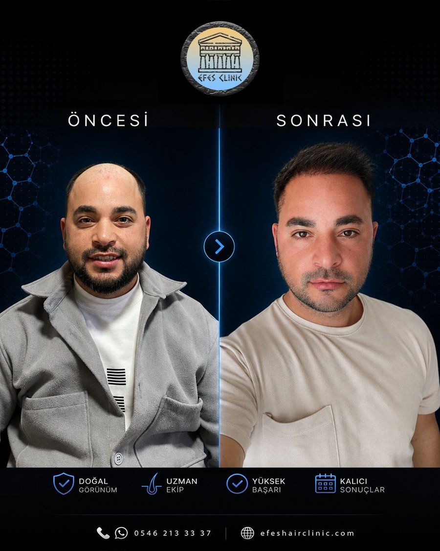Efes Clinic İzmir saç ekimi öncesi sonrası
