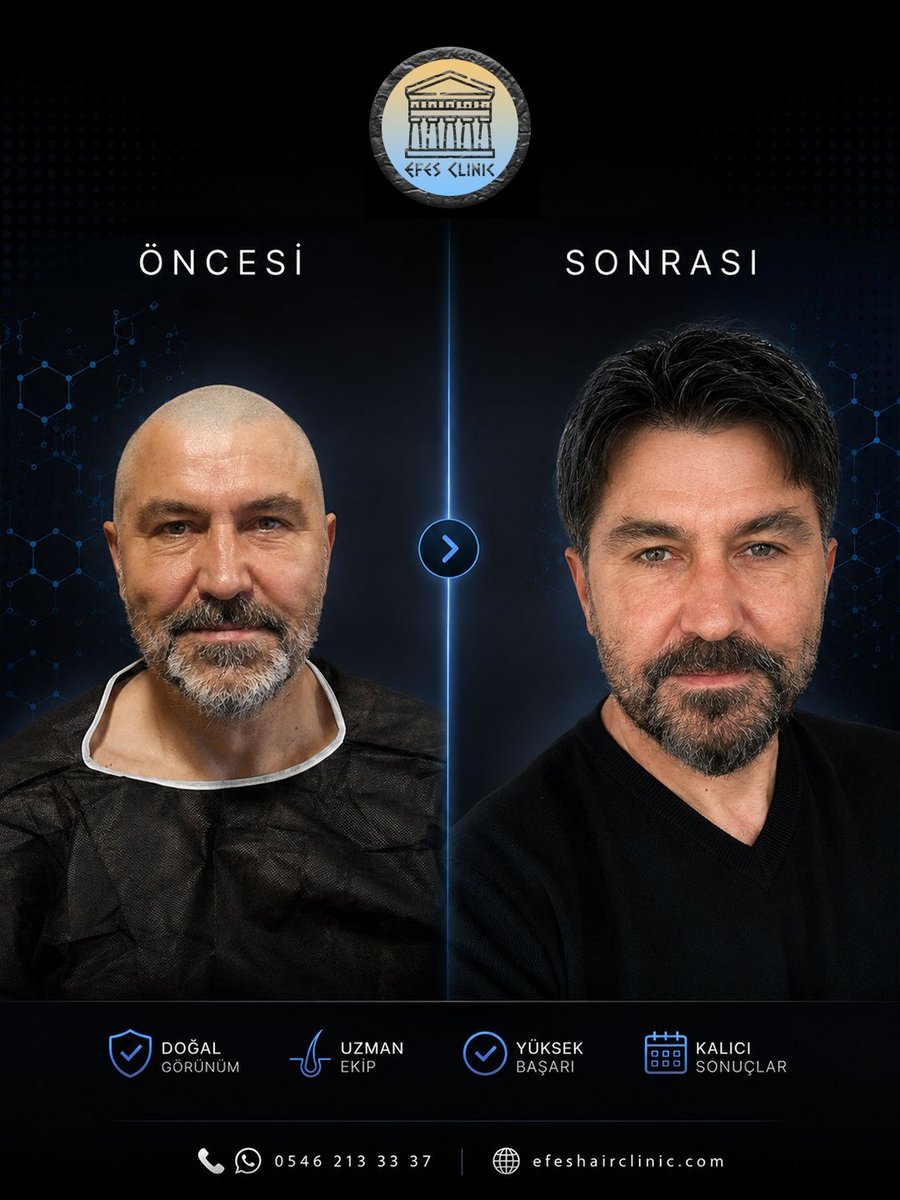 Efes Clinic İzmir saç ekimi öncesi sonrası