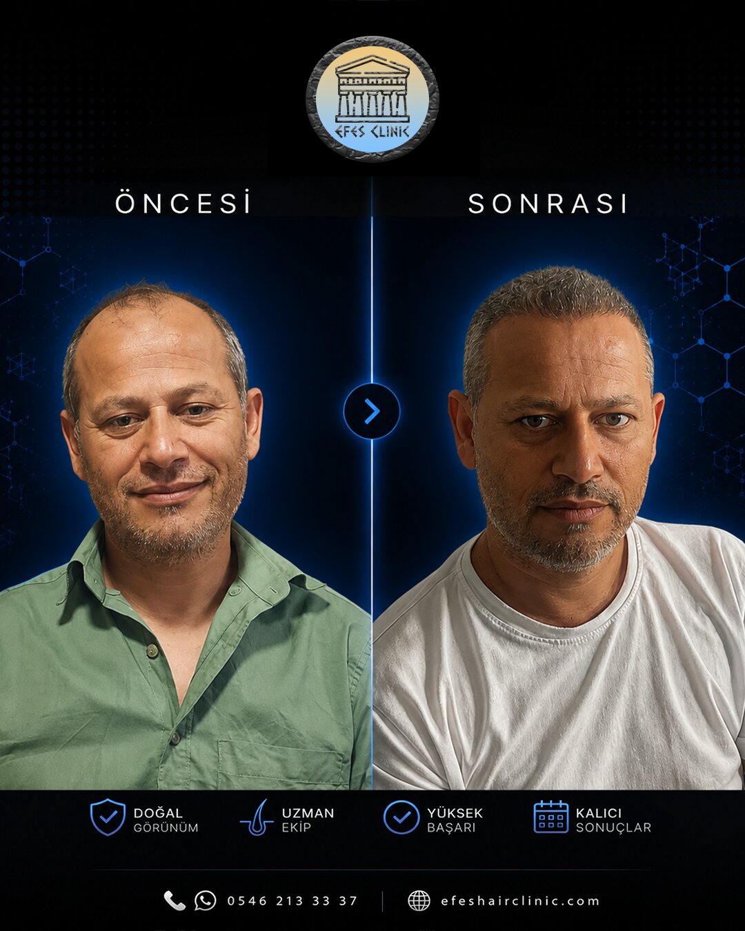 Efes Clinic İzmir saç ekimi öncesi sonrası